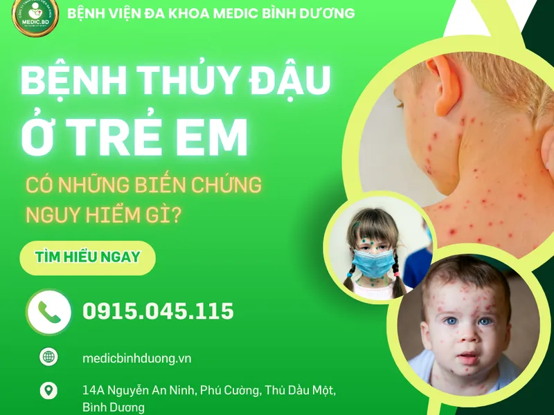 THUỶ ĐẬU LÀ GÌ? TRIỆU CHỨNG, NGUYÊN NHÂN VÀ CÁCH ĐIỀU TRỊ HIỆU QUẢ
