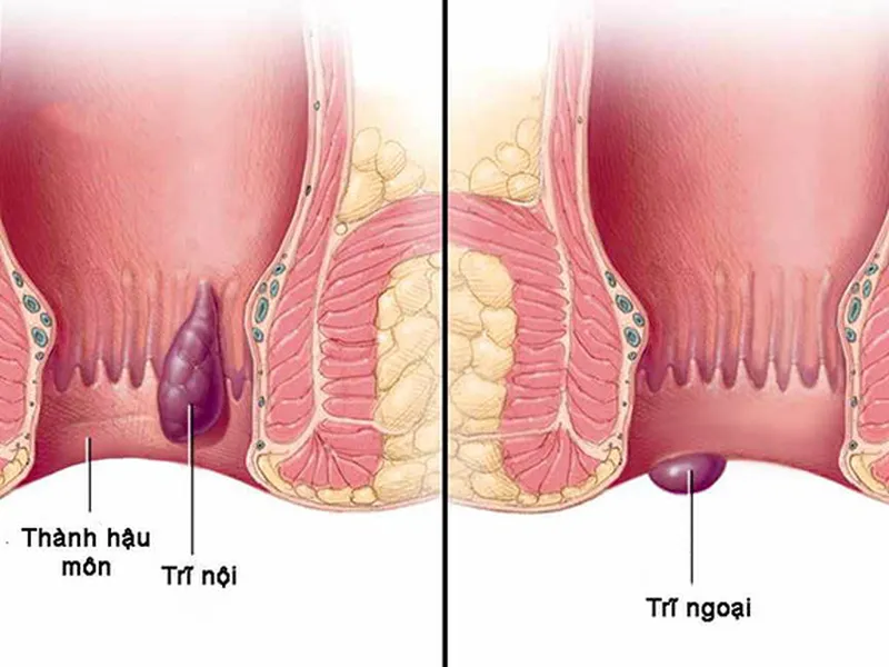 BỆNH TRĨ VÀ NHỮNG ĐIỀU CẦN LƯU Ý