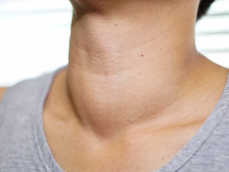 BỆNH CƯỜNG GIÁP: NGUYÊN NHÂN, TRIỆU CHỨNG VÀ CÁCH PHÒNG NGỪA