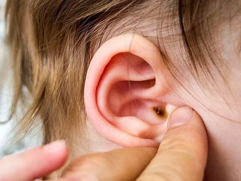 VIÊM TAI GIỮA Ở TRẺ EM: NGUYÊN NHÂN, TRIỆU CHỨNG VÀ CÁC PHƯƠNG PHÁP ĐIỀU TRỊ