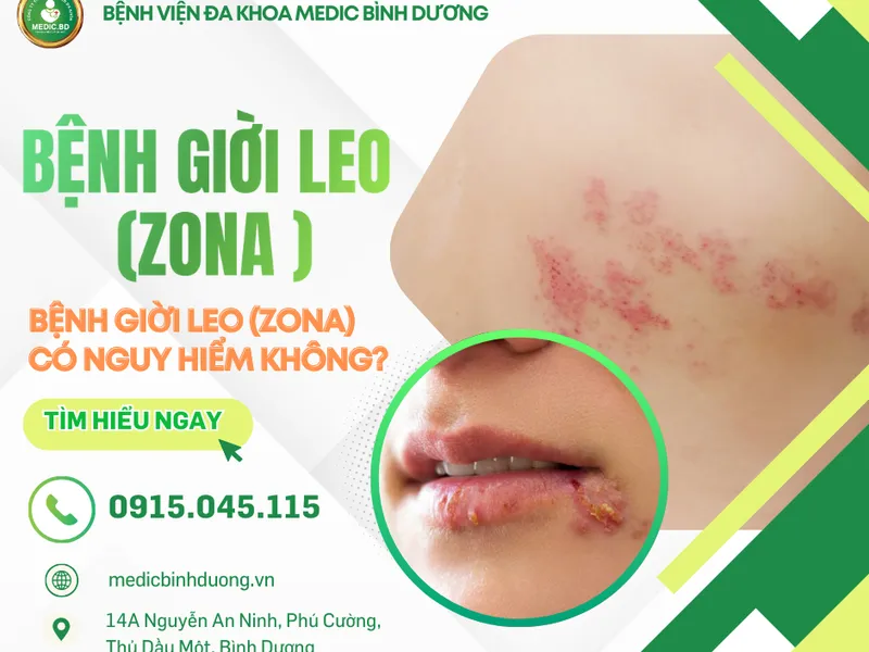 BỆNH GIỜI LEO CÓ NGUY HIỂM? BIẾN CHỨNG & CÁCH ĐIỀU TRỊ HIỆU QUẢ