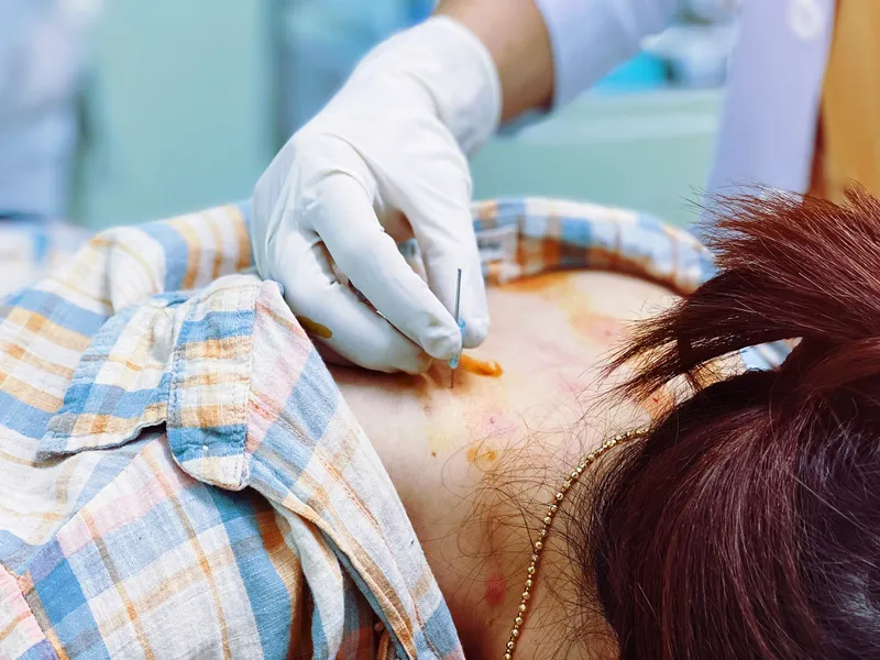 LIỆU PHÁP CẤY CHỈ ĐIỀU TRỊ ĐAU VAI