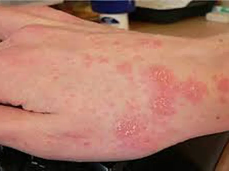 CÁC DẤU HIỆU CỦA GHẺ NGỨA