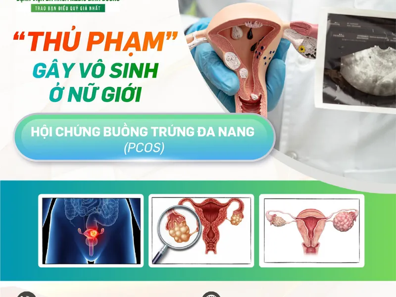 ĐA NANG BUỒNG TRỨNG