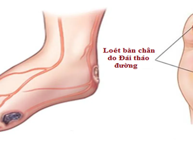 CHĂM SÓC BÀN CHÂN ĐÁI THÁO ĐƯỜNG