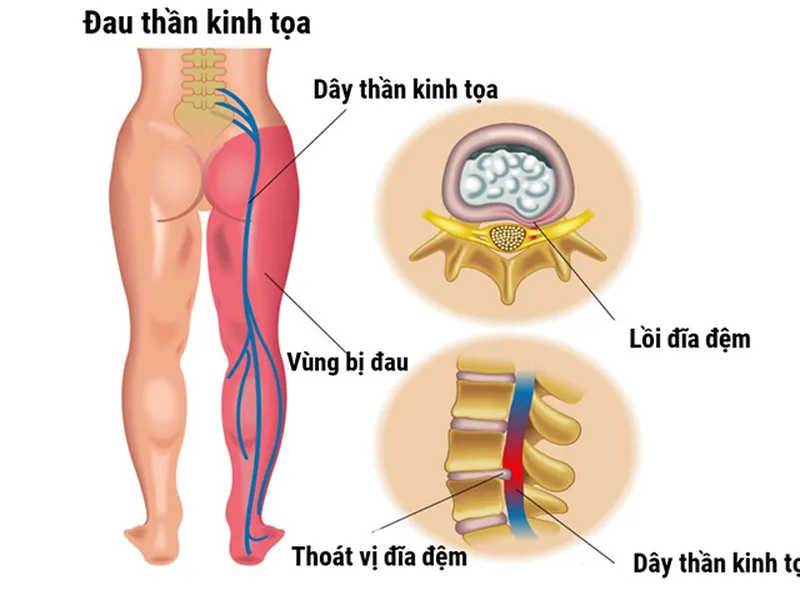 Đau dây thần kinh Tọa là gì?