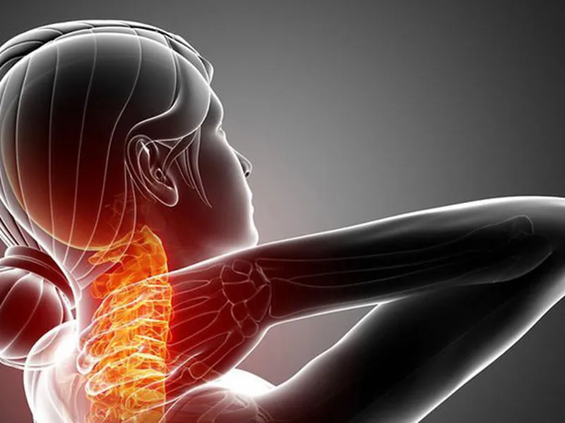 HỘI CHỨNG CĂNG ĐAU VAY GÁY