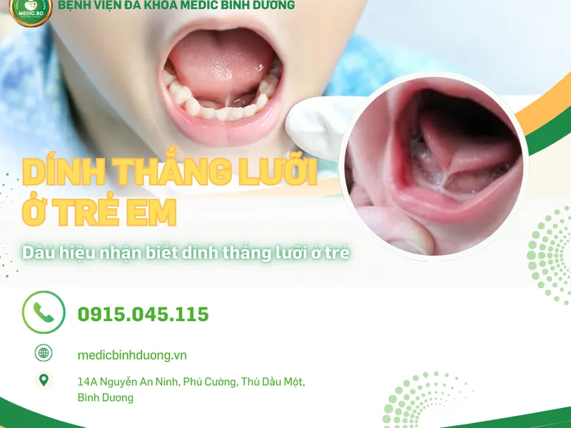 DÍNH THẮNG LƯỠI Ở TRẺ: DẤU HIỆU, ẢNH HƯỞNG VÀ CÁCH PHÒNG NGỪA