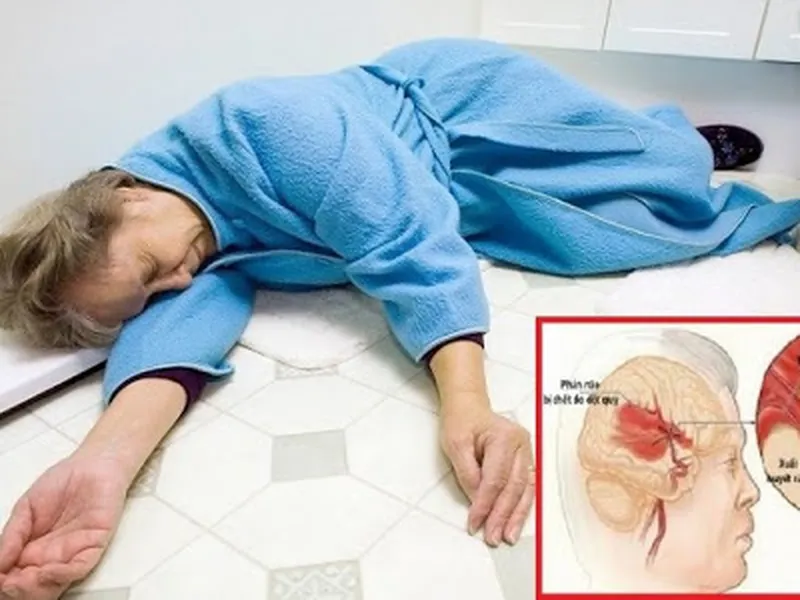 ĐIỀU TRỊ DI CHỨNG LIỆT NỬA NGƯỜI (BÁN THÂN BẤT TOẠI)  DO TAI BIẾN MẠCH MÁU NÃO  BẰNG TÂY Y VÀ ĐÔNG Y KẾT HỢP