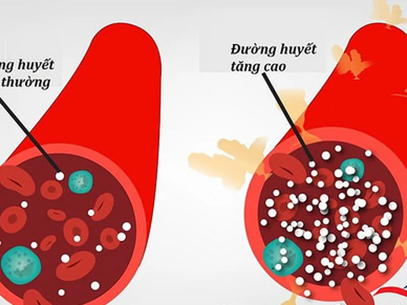 BỆNH ĐÁI THÁO ĐƯỜNG