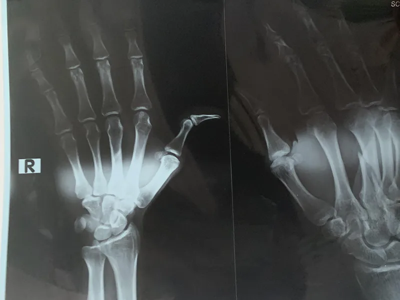 CẢNH GIÁC VỚI GÃY XƯƠNG KÍN