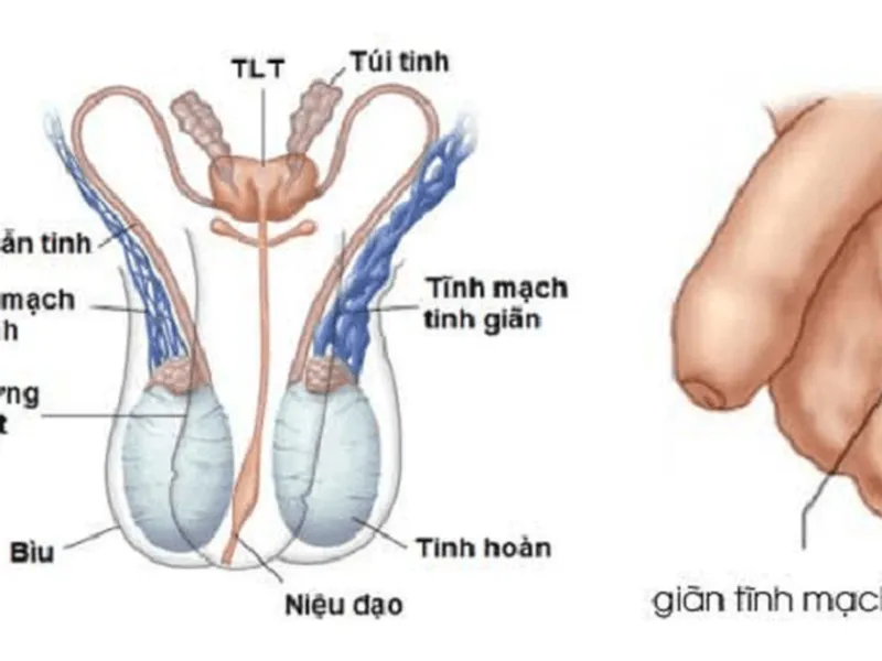 GIÃN TĨNH MẠCH THỪNG TINH CÓ LÀM ẢNH HƯỞNG ĐẾN SINH LÝ?