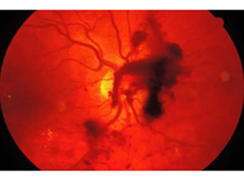 TẦM SOÁT BỆNH VÕNG MẠC DO ĐÁI THÁO ĐƯỜNG