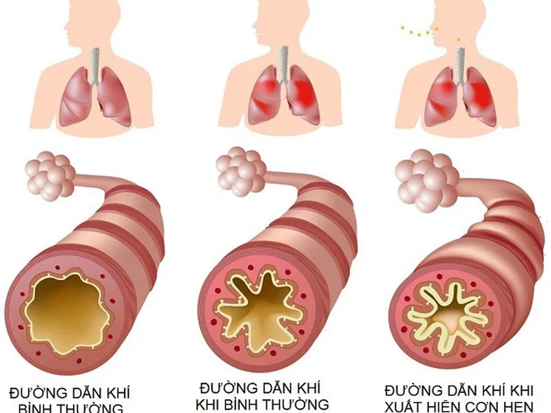 TẦM SOÁT HEN PHẾ QUẢN BẰNG PHƯƠNG PHÁP ĐO CHỨC NĂNG HÔ HẤP