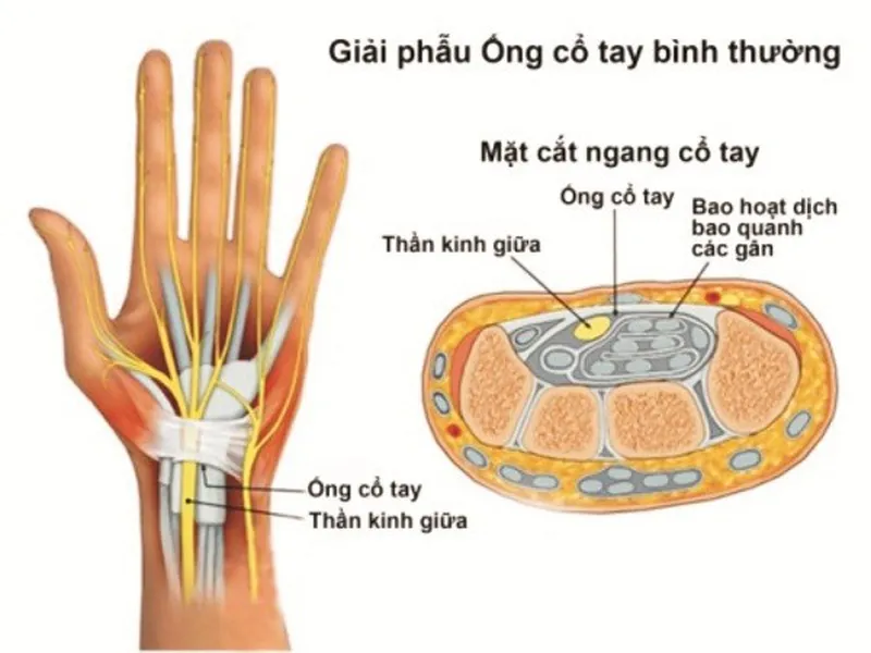 TÌM HIỂU VÀ ĐIỀU TRỊ HỘI CHỨNG ỐNG CỔ TAY