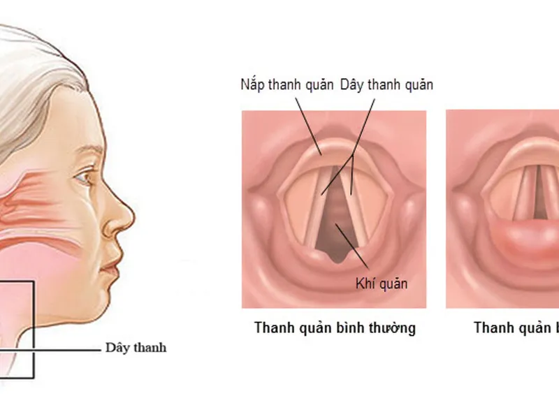 KHÀN TIẾNG KÉO DÀI  - NGUYÊN NHÂN VÀ HƯỚNG ĐIỀU TRỊ