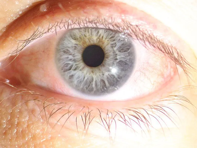 ĐIỀU TRỊ KHÔ MẮT