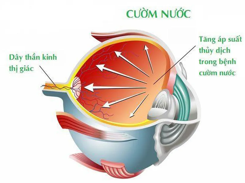 BỆNH GLAUCOMA (CƯỜM NƯỚC) VÀ NHỮNG ĐIỀU CẦN BIẾT