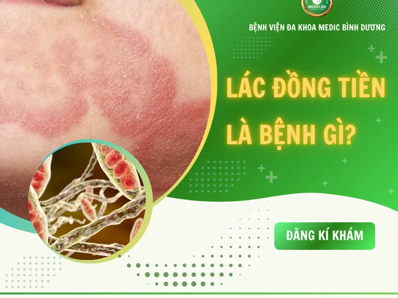 BỆNH LÁC ĐỒNG TIỀN: TRIỆU CHỨNG, NGUYÊN NHÂN VÀ CÁCH PHÒNG TRÁNH