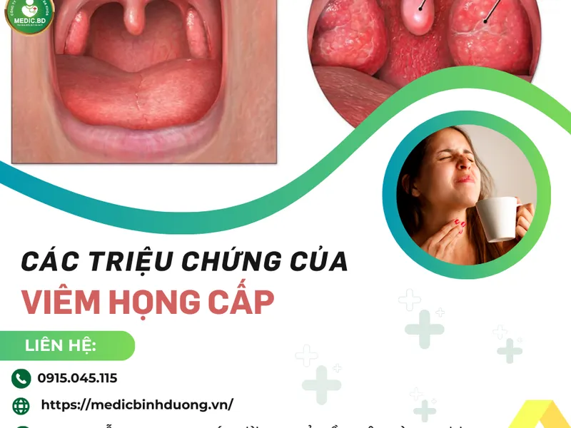 VIÊM HỌNG CẤP: NGUYÊN NHÂN, TRIỆU CHỨNG VÀ PHƯƠNG PHÁP ĐIỀU TRỊ