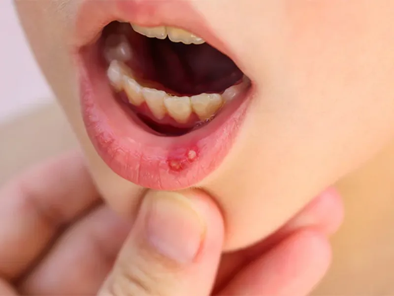 LOÉT MIỆNG CÓ NGUY HIỂM KHÔNG?