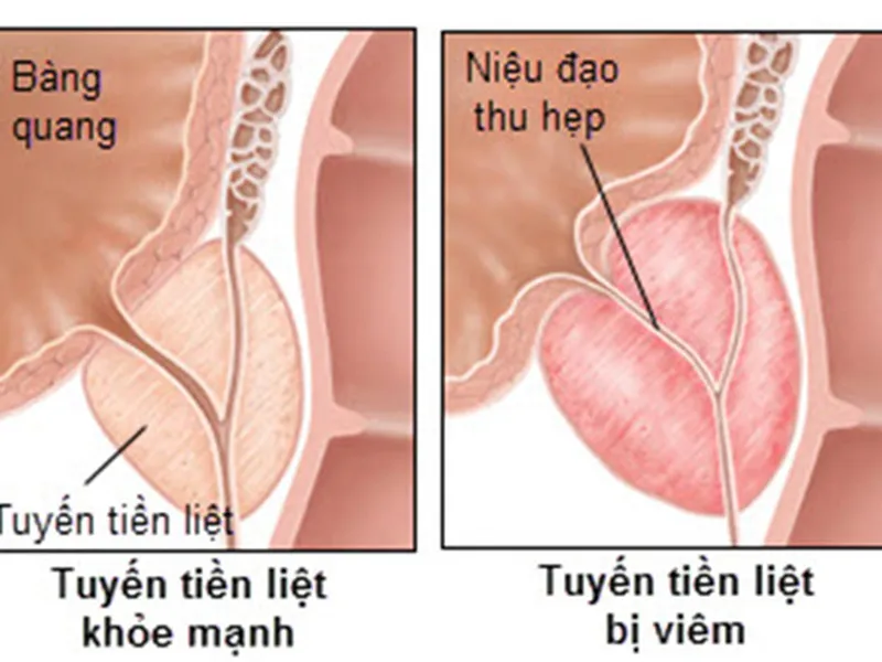 PHÒNG NGỪA UNG THƯ TUYẾN TIỀN LIỆT