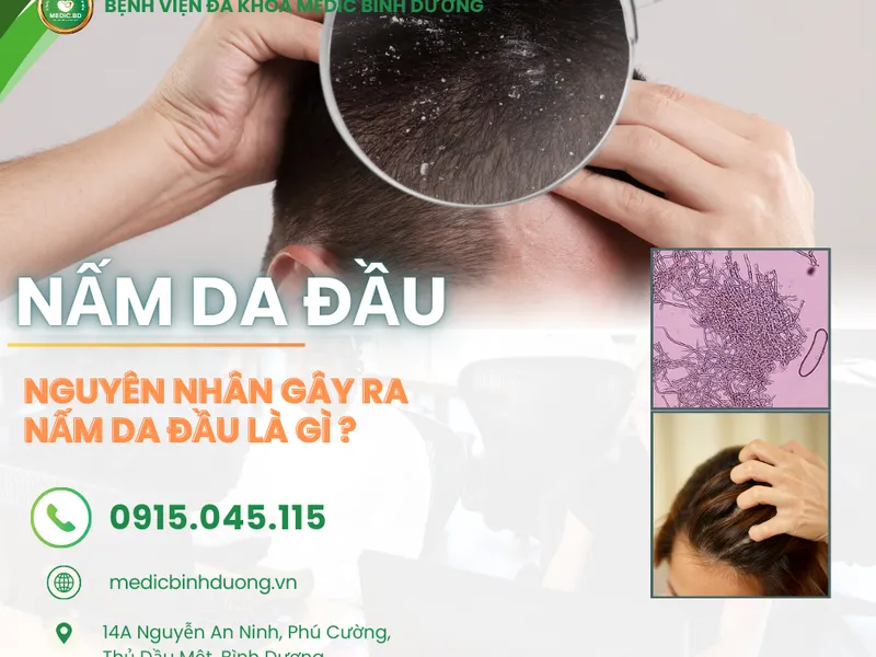 NẤM DA ĐẦU: NGUYÊN NHÂN, TRIỆU CHỨNG VÀ PHƯƠNG PHÁP ĐIỀU TRỊ