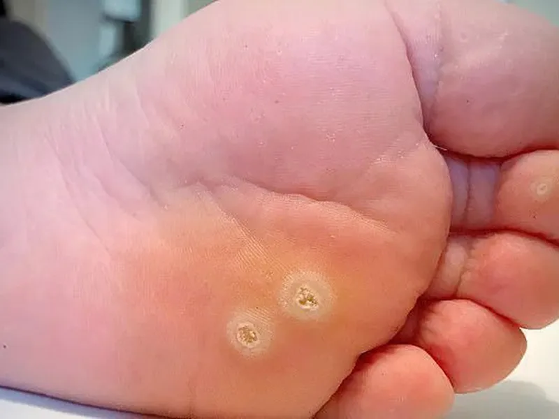 MỤN CÓC Ở CHÂN: NGUYÊN NHÂN, TRIỆU CHỨNG VÀ CÁCH PHÒNG NGỪA