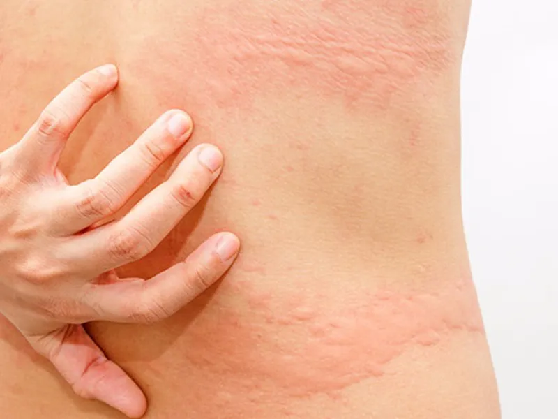 MỀ ĐAY CẤP TÍNH: NGUYÊN NHÂN, TRIỆU CHỨNG VÀ CÁCH XỬ LÝ AN TOÀN, HIỆU QUẢ