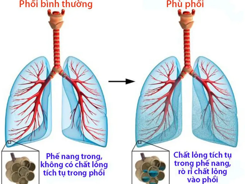 BỆNH PHÙ PHỔI VÀ NHỮNG ĐIỀU CẦN BIẾT ĐỂ ĐỀ PHÒNG HIỆU QUẢ.