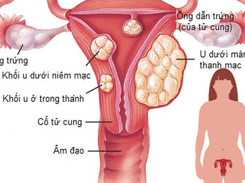 U XƠ TỬ CUNG: NGUYÊN NHÂN, DẤU HIỆU VÀ CÁCH ĐIỀU TRỊ HIỆU QUẢ