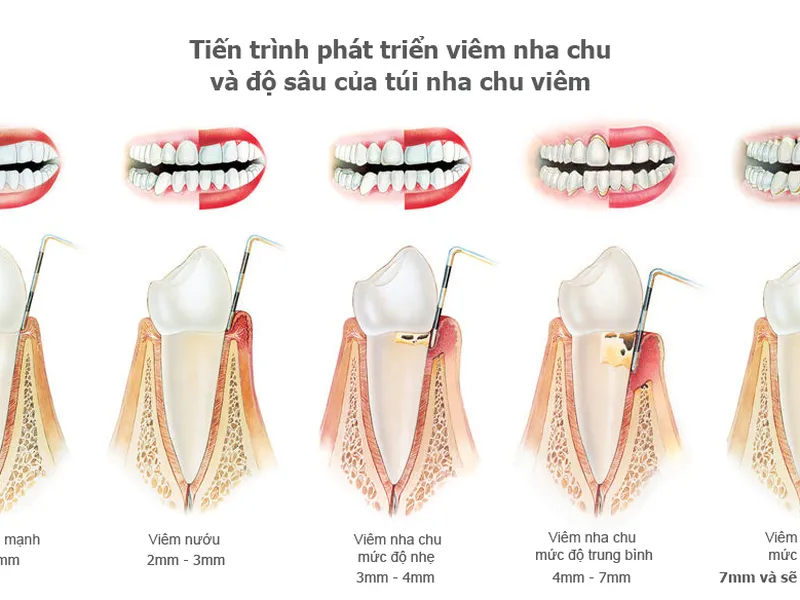 BỆNH NHA CHU NGUY HIỂM NHƯ THẾ NÀO?