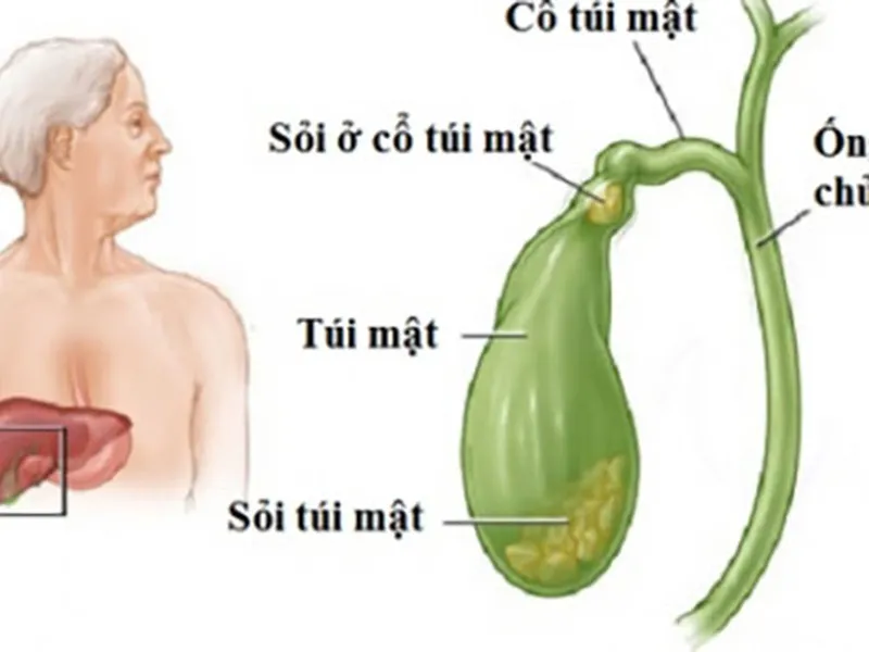 DẤU HIỆU VÀ ĐIỀU TRỊ SỎI MẬT TẠI  BỆNH VIỆN ĐA KHOA MEDIC BÌNH DƯƠNG
