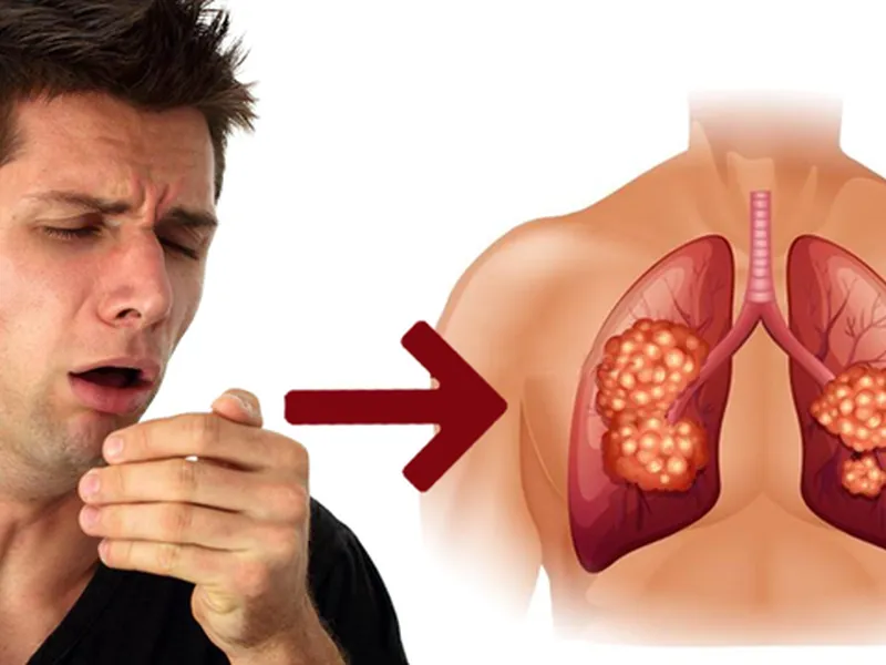 NGUYÊN NHÂN GÂY HO KÉO DÀI