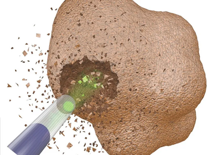 TÁN SỎI BẰNG LASER – CUỘC CÁCH MẠNG TRONG ĐIỀU TRỊ SỎI ĐƯỜNG TIẾT NIỆU