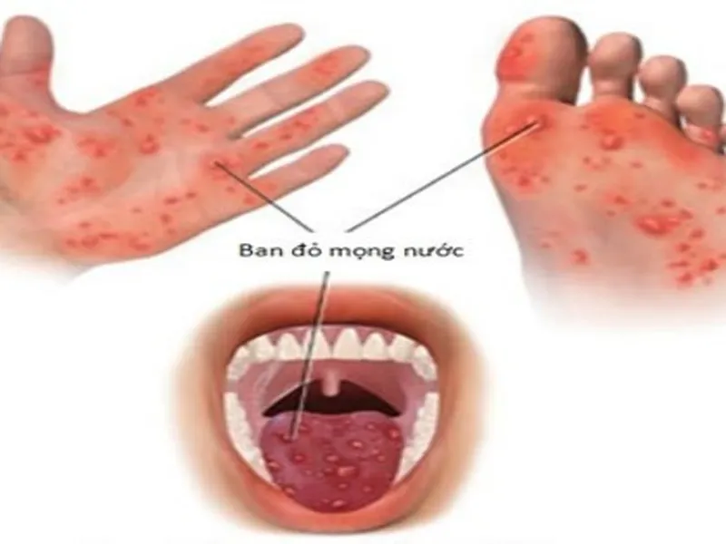 PHÒNG NGỪA TAY CHÂN MIỆNG CHO TRẺ EM.
