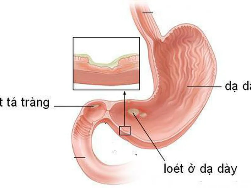 DẤU HIỆU CẢNH BÁO VIÊM LOÉT DẠ DÀY Ở TRẺ BỐ MẸ NHẤT ĐỊNH PHẢI BIẾT