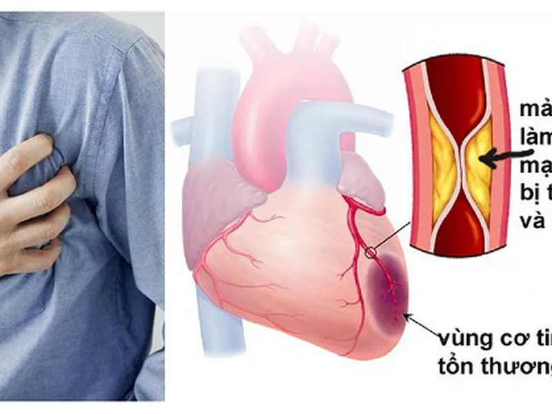 DẤU HIỆU NHẬN BIẾT BỆNH MẠCH VÀNH