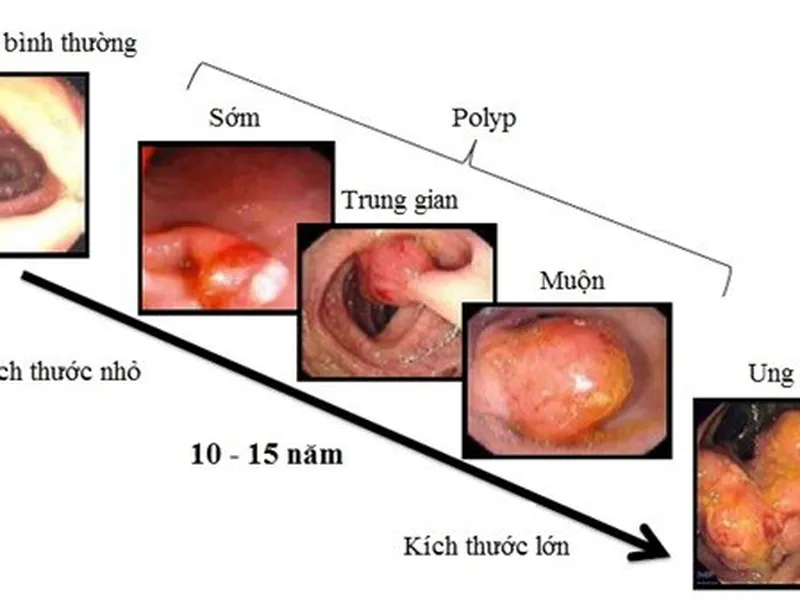 TẦM SOÁT UNG THƯ ĐẠI TRỰC TRÀNG