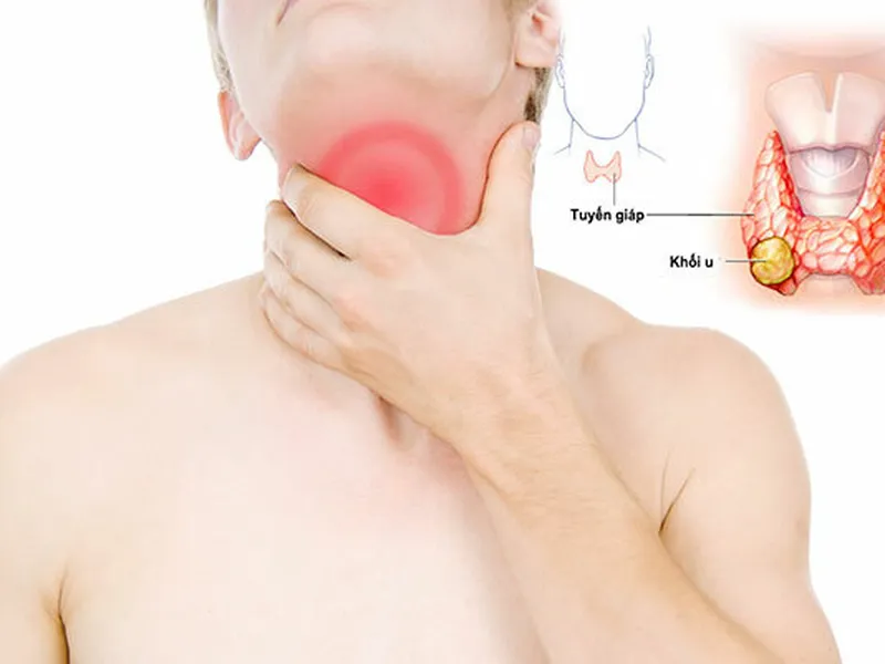 UNG THƯ TUYẾN GIÁP ẢNH HƯỞNG THẾ NÀO ĐẾN SỨC KHỎE?