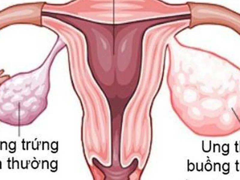 DẤU HIỆU ĐIỂN HÌNH CẢNH BÁO UNG THƯ BUỒNG TRỨNG