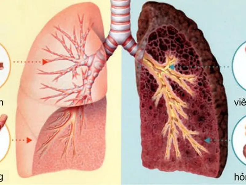 NGUYÊN NHÂN VÀ TRIỆU CHỨNG BỆNH UNG THƯ PHỔI