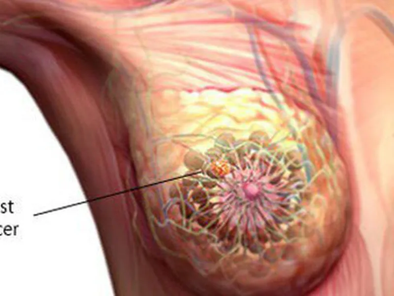 UNG THƯ VÚ – NỖI LO ĐẾN TỪ SỰ THỜ Ơ