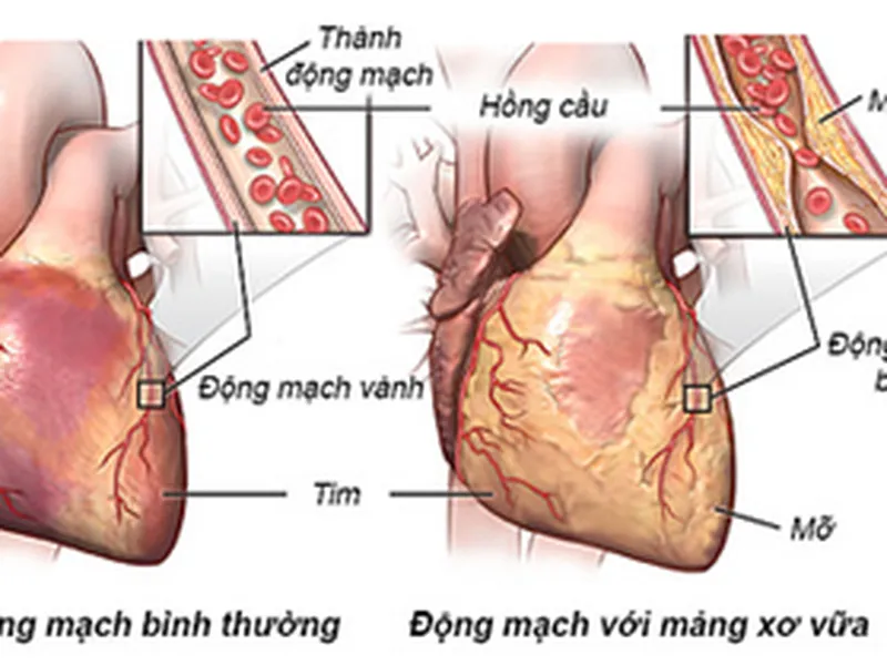THIẾU MÁU CƠ TIM MẠN TÍNH