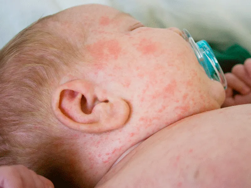 VIÊM DA CƠ ĐỊA Ở TRẺ EM CÓ THỂ GÂY BIẾN CHỨNG NGUY HIỂM