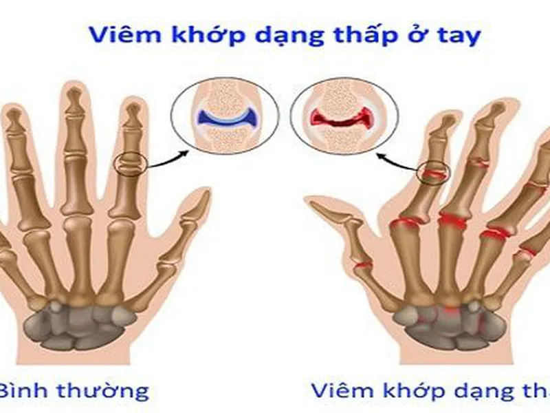 BIỂU HIỆN CỦA VIÊM KHỚP XƯƠNG MẠN TÍNH