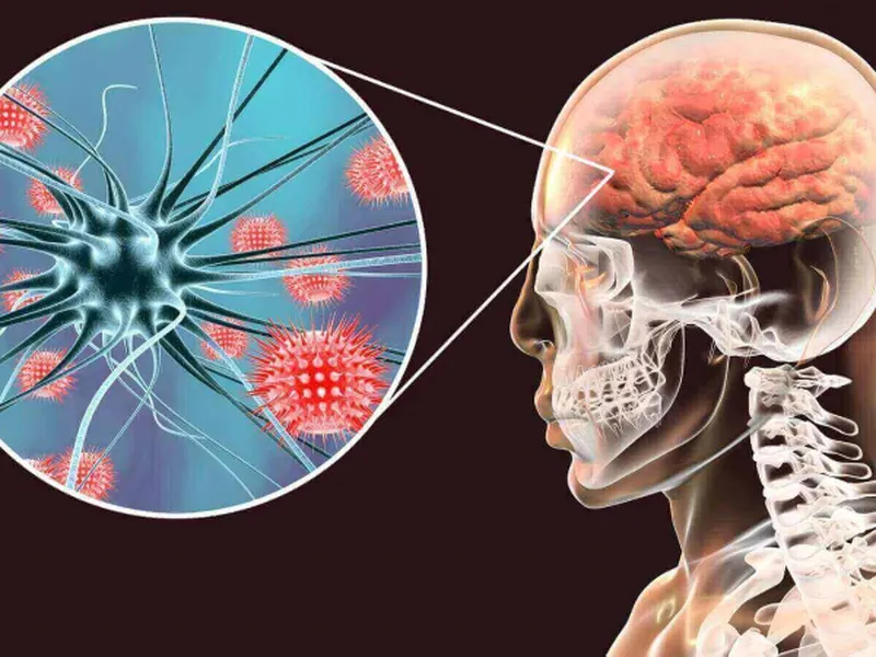VIÊM MÀNG NÃO DO VI KHUẨN: NGUYÊN NHÂN, TRIỆU CHỨNG, BIẾN CHỨNG VÀ CÁCH PHÒNG NGỪA