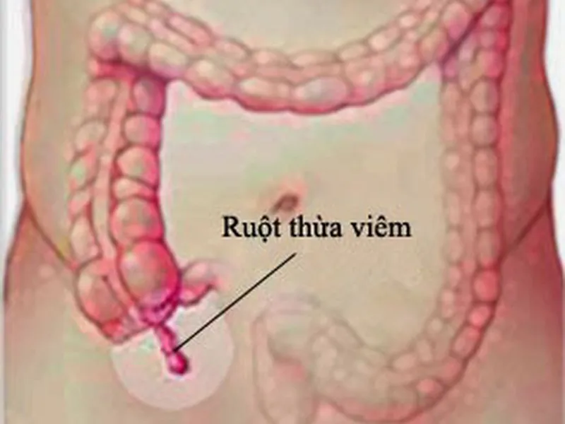 DẤU HIỆU VÀ TRIỆU CHỨNG NHẬN BIẾT SỚM ĐAU RUỘT THỪA