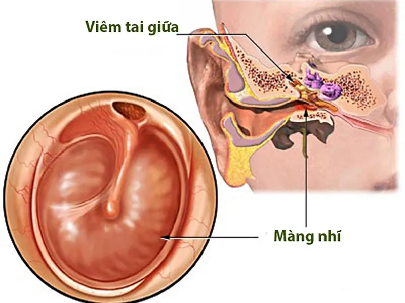 CÁC PHƯƠNG PHÁP ĐIỀU TRỊ VIÊM TAI GIỮA