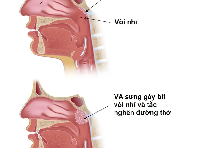 Viêm V.A và những điều cần biết?